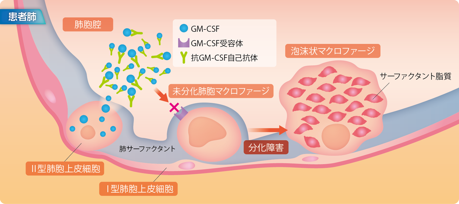 自己免疫性肺胞蛋白症の発症機序イメージ図。自己免疫性肺胞蛋白症患者では、抗GM-CSF自己抗体が過剰に産生され、GM-CSFによる肺胞マクロファージの分化が阻害されることで、サーファクタントの分解が阻害されます。その結果、肺胞内に肺サーファクタント由来の不溶性物質が蓄積し、ガス交換が十分にできなくなることで、呼吸不全を引き起こします。